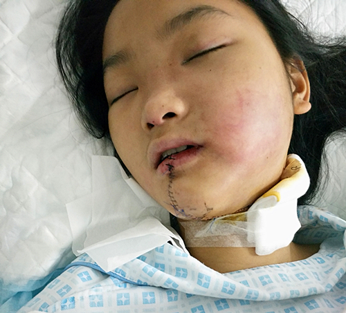 安徽阜阳15岁女孩孙文艳患左颊部横纹肌肉瘤,急需救助!